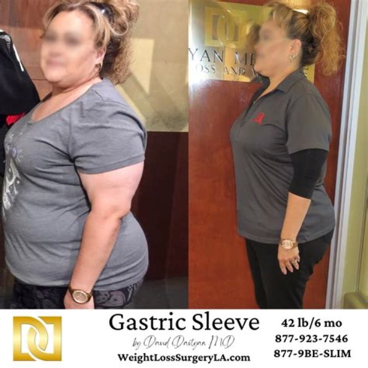 Can you put weight back on after gastric sleeve?