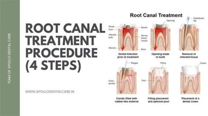 Is root canal safe for teeth?